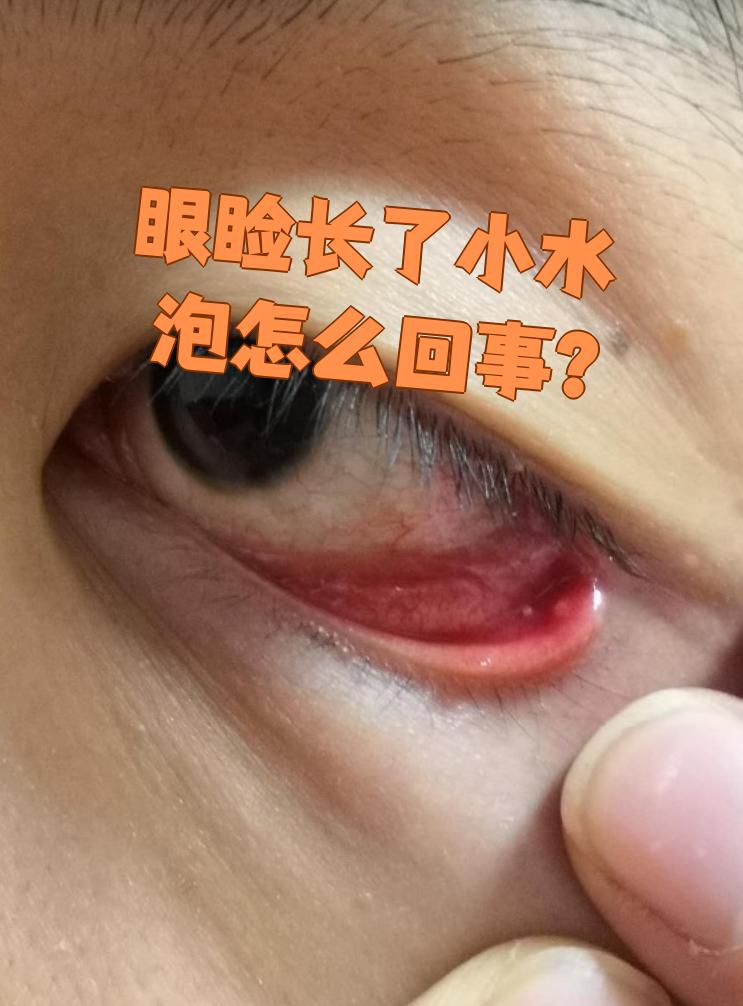 眼睑长小水泡最常见的原因是过敏,眼睑疖肿,疱疹或湿疹