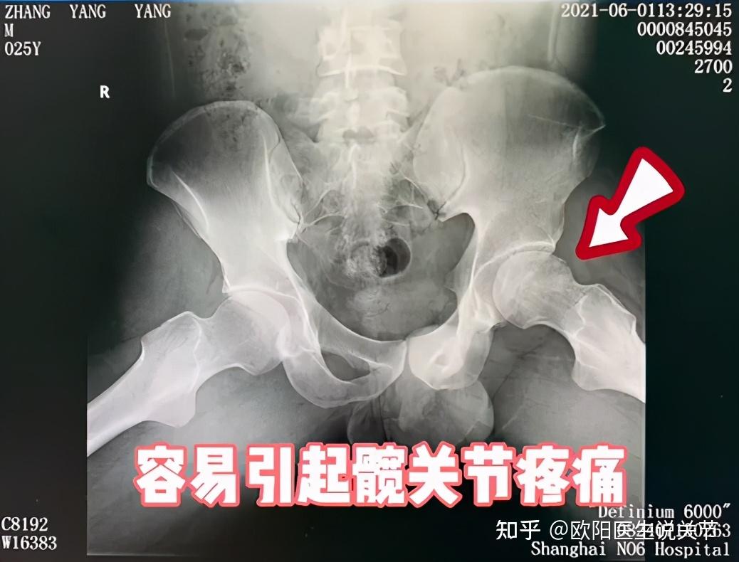 年轻小伙长期服用激素股骨头坏死微创髓芯减压植骨成功保髋