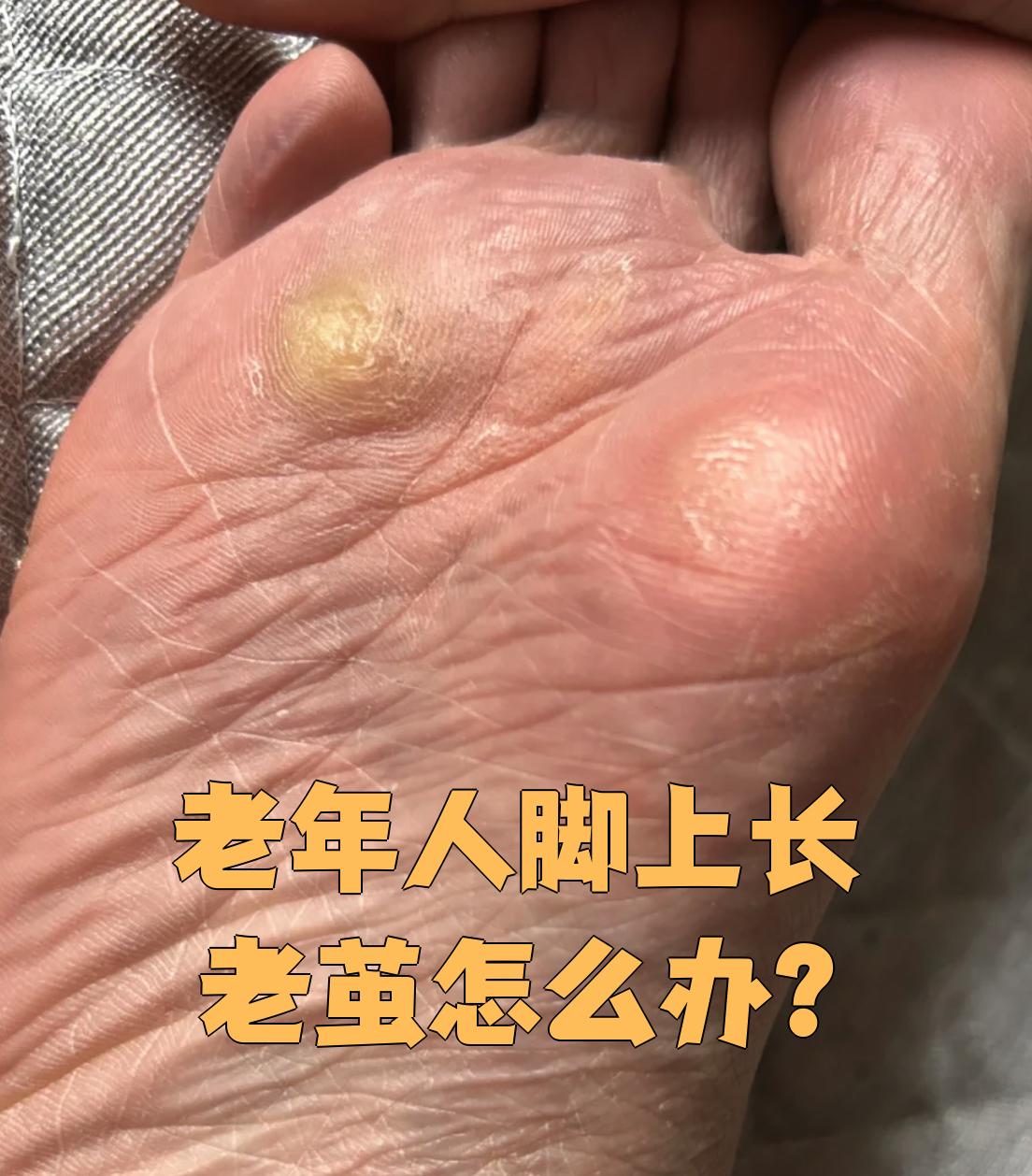 老年人脚上长老茧怎么办?
