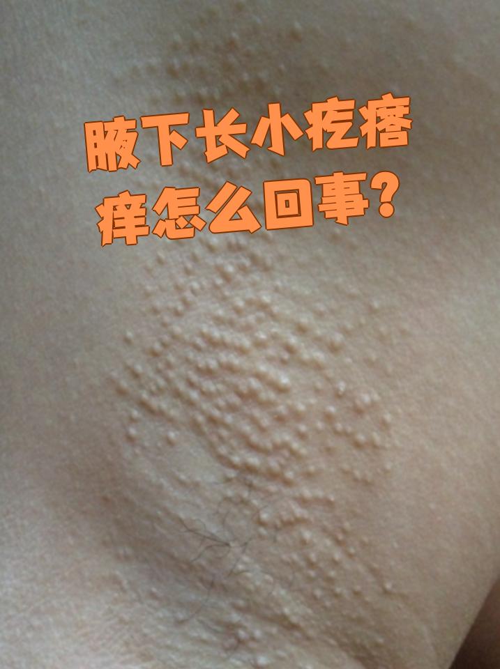 毛囊发炎会让腋下冒出小疙瘩,还会觉得痒