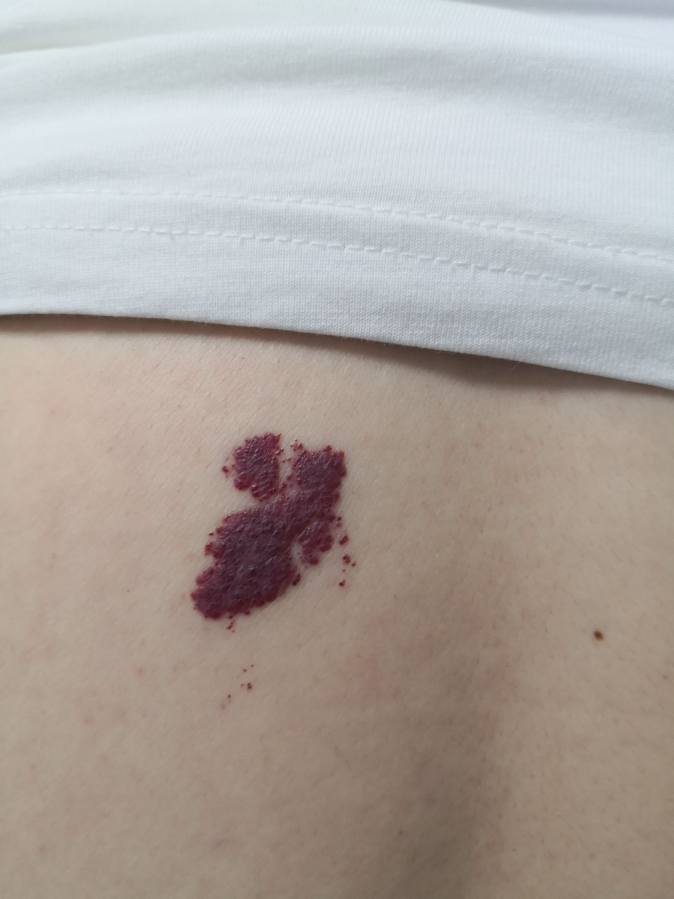 背部草莓状血管瘤症状#血管瘤##鲜红斑痣# 可以使用药物配合激光治疗.