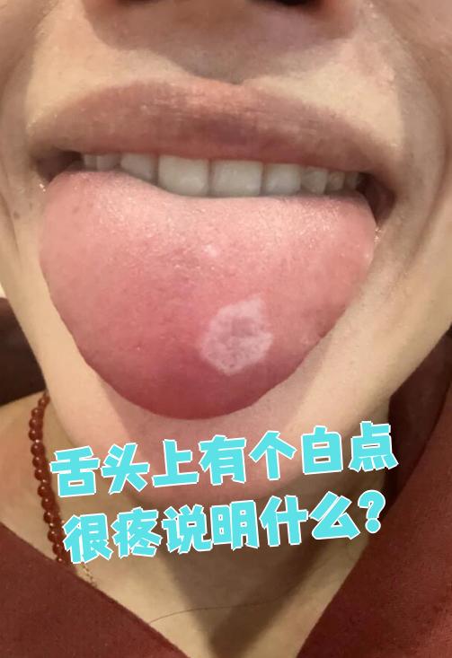 舌头上出现白点并且疼痛,可能是口腔溃疡,鹅口疮或扁平苔藓等问题