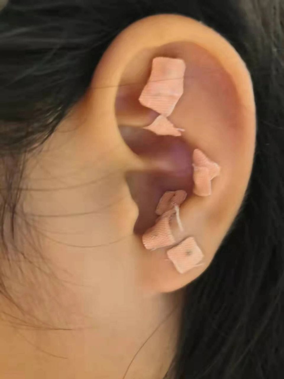 近视防控|贴耳豆 几个月前,听别人说她家孩子小时候贴耳豆治疗近视.