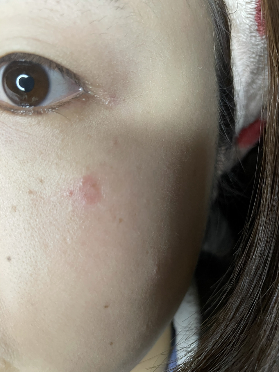 前几天脸上莫名出现一块红色,比较红,但感觉不咋痒