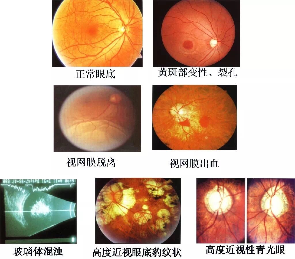 如何规避高度近视带来的并发症?