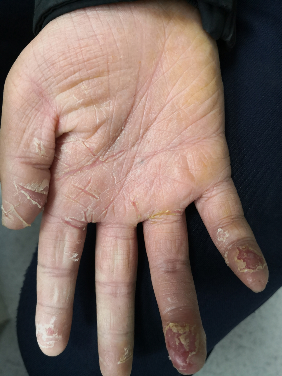 儿童双手干燥角化过度脱屑裂口症状.