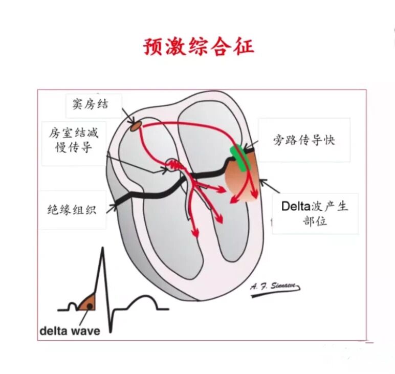 看图记忆(预激综合征) 71预激综合征(preexcitation syndrome),又称