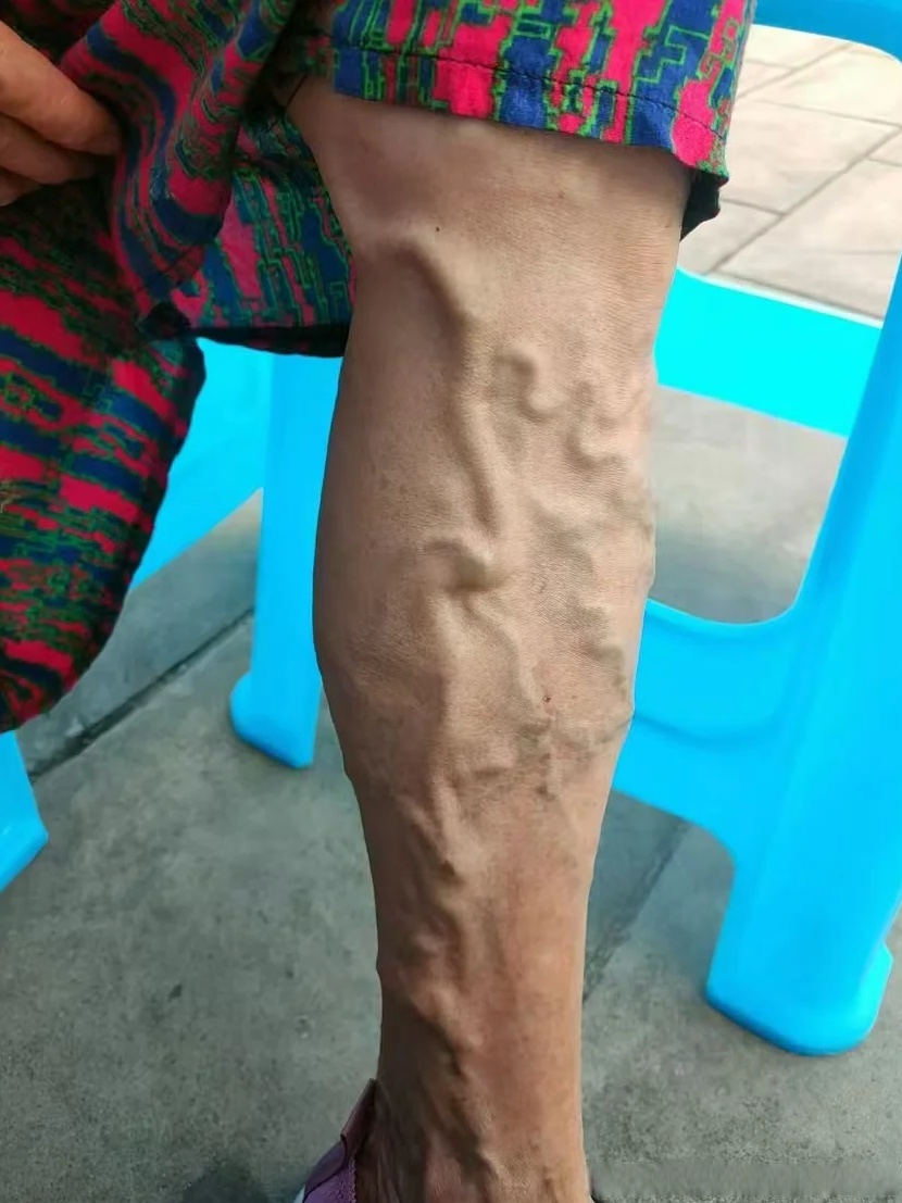 静脉曲张早期警示:腿部沉重,肿胀,久站久坐后更明显