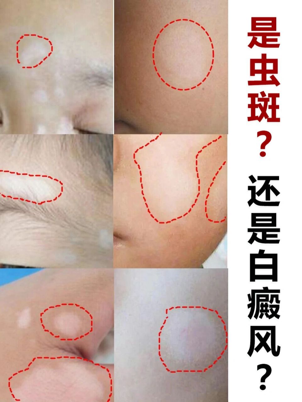 孩子脸上总有白斑,是虫斑还是白癜风71 小朋友脸上出现 经常看到