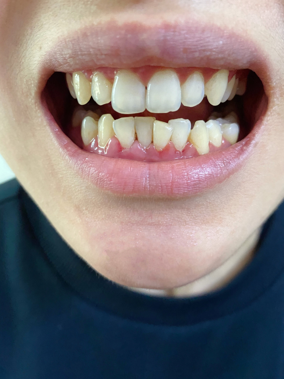 牙周炎龈下刮治前后 轻中度,没用麻药,龈下刮治过程一个多小时,太煎熬