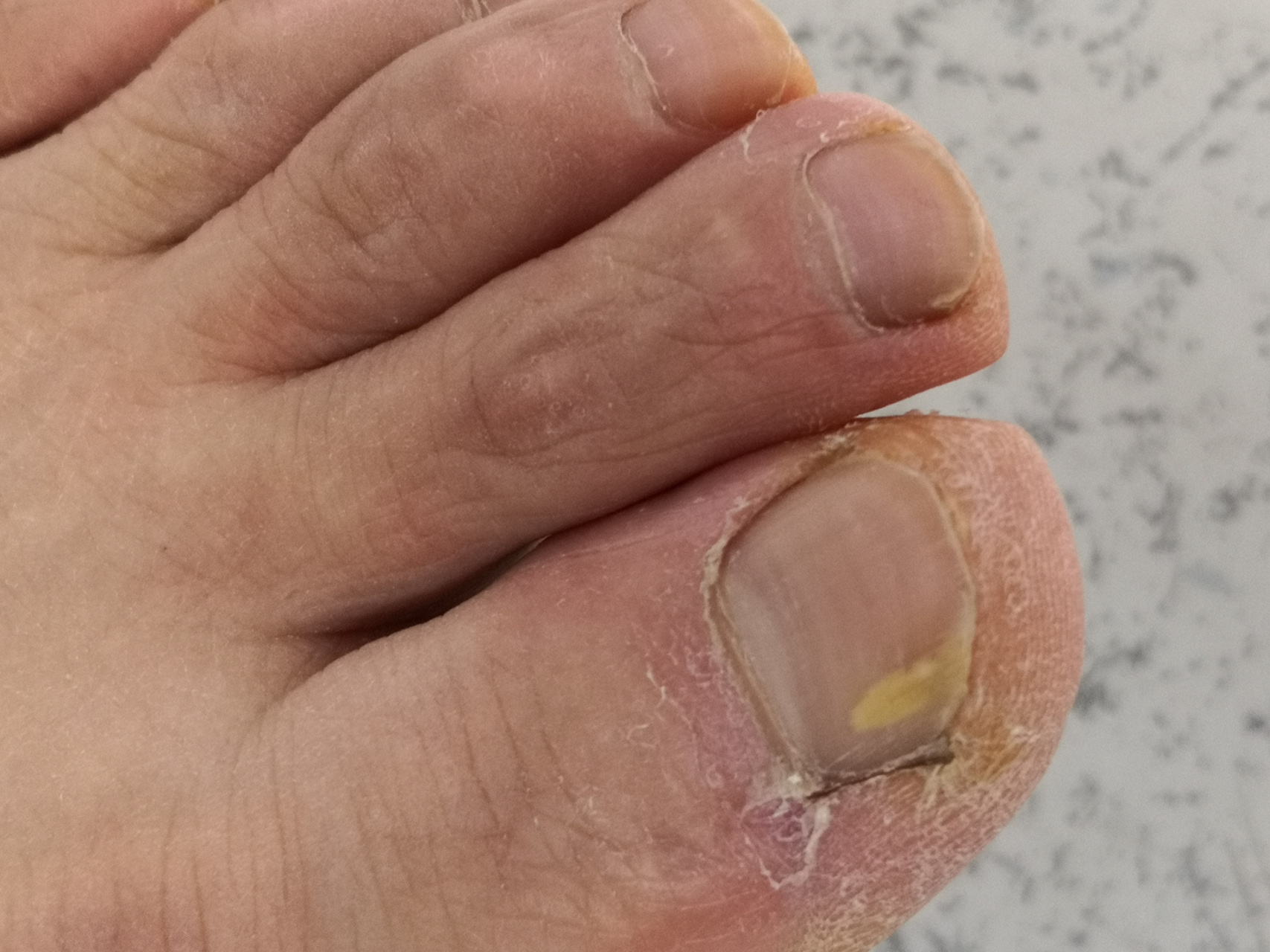 灰指甲甲癣症状#灰指甲