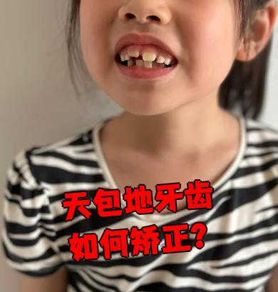天包地牙齿也叫"龅牙",属于错颌畸形的一种