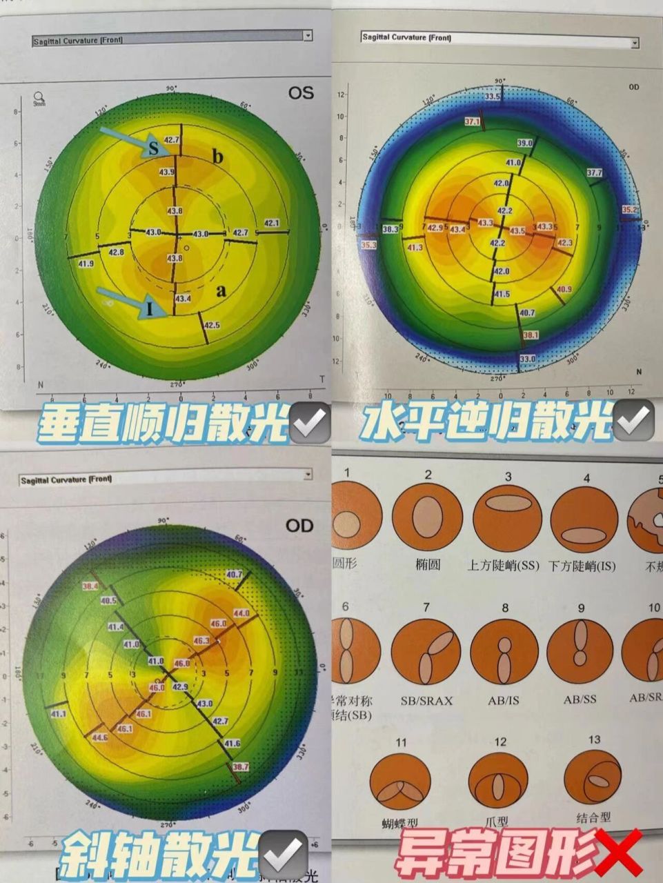 角膜地形图怎么看图片