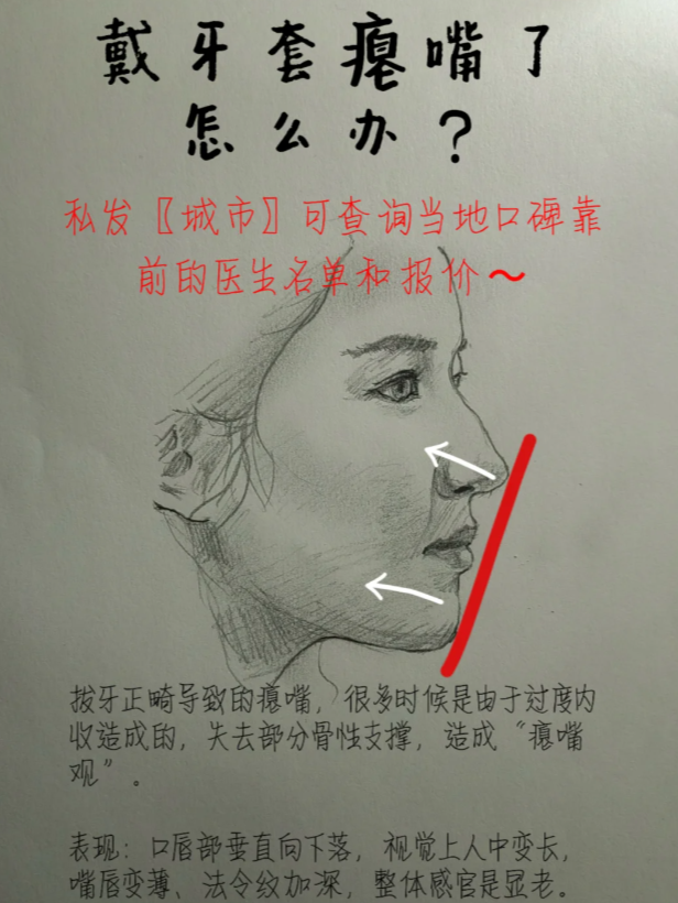 避免后面矫正结束造成了真憋嘴瘪嘴面相