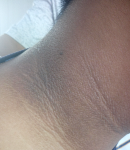 10岁女孩脖子黑洗不干净怎么办?