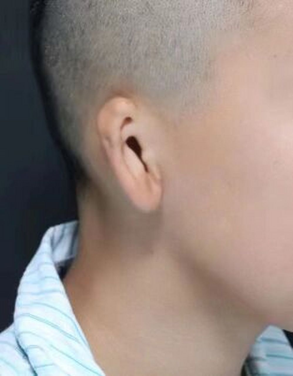 张正文教授# #张正文耳再造# #耳再造# #小耳畸形