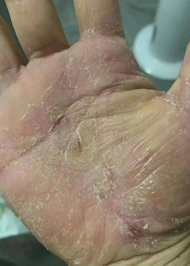 鹅掌风是什么皮肤病?有什么治疗方法?