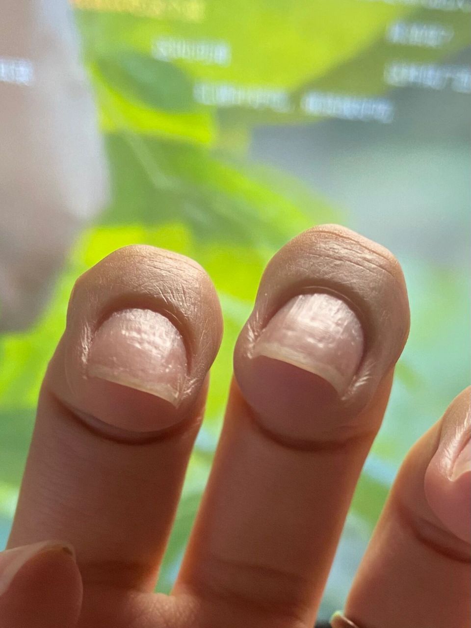 手指甲凹陷是怎么回事图片