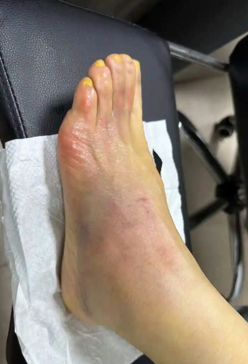 崴脚后脚踝和脚面出现淤青发紫,这其实是皮下出血的表现
