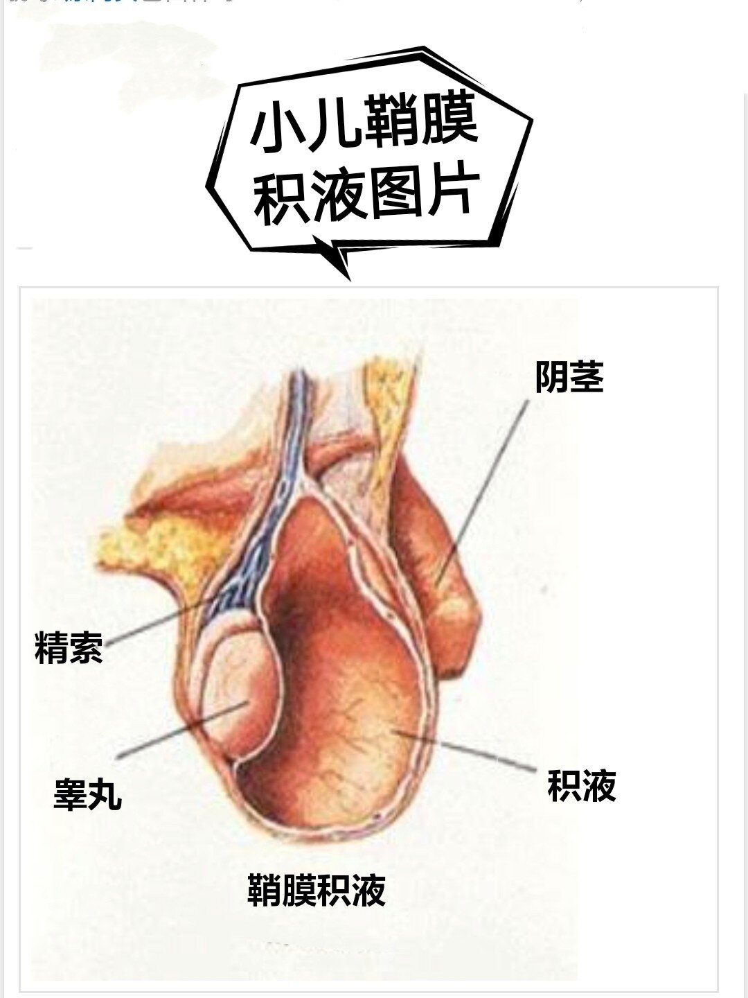 偏方治好了我儿子的小儿鞘膜积液