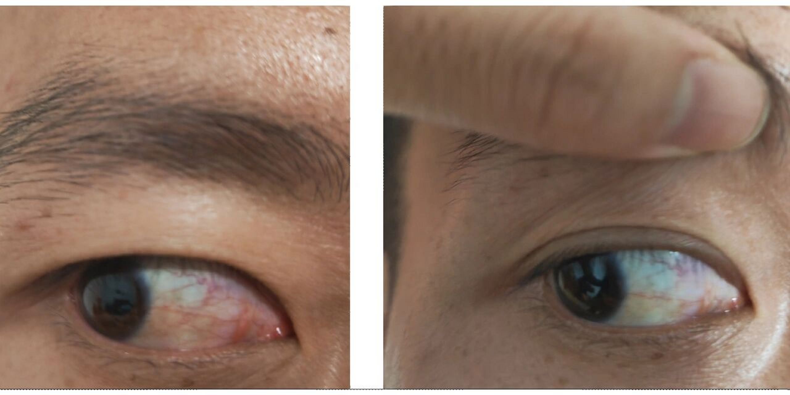 扩张充血,淤血或出血时,即可呈现眼白发 眼睛充血不只是影响颜值那么