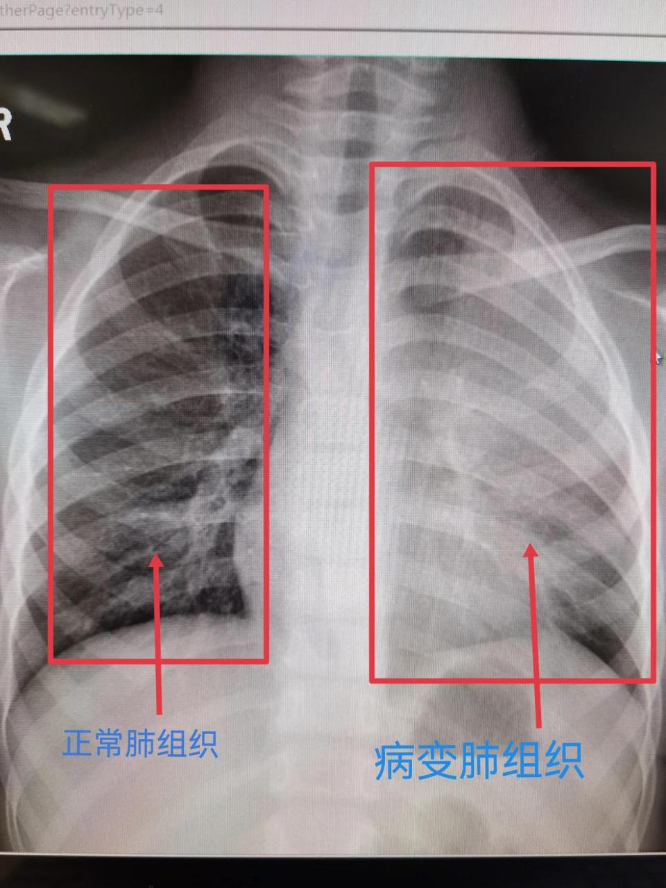 像这种情况,靠自身免疫力自愈或者门急诊口服药治疗都是行不通的