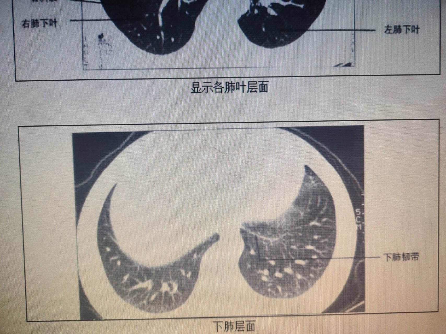 正常肺部肺窗ct影像解剖