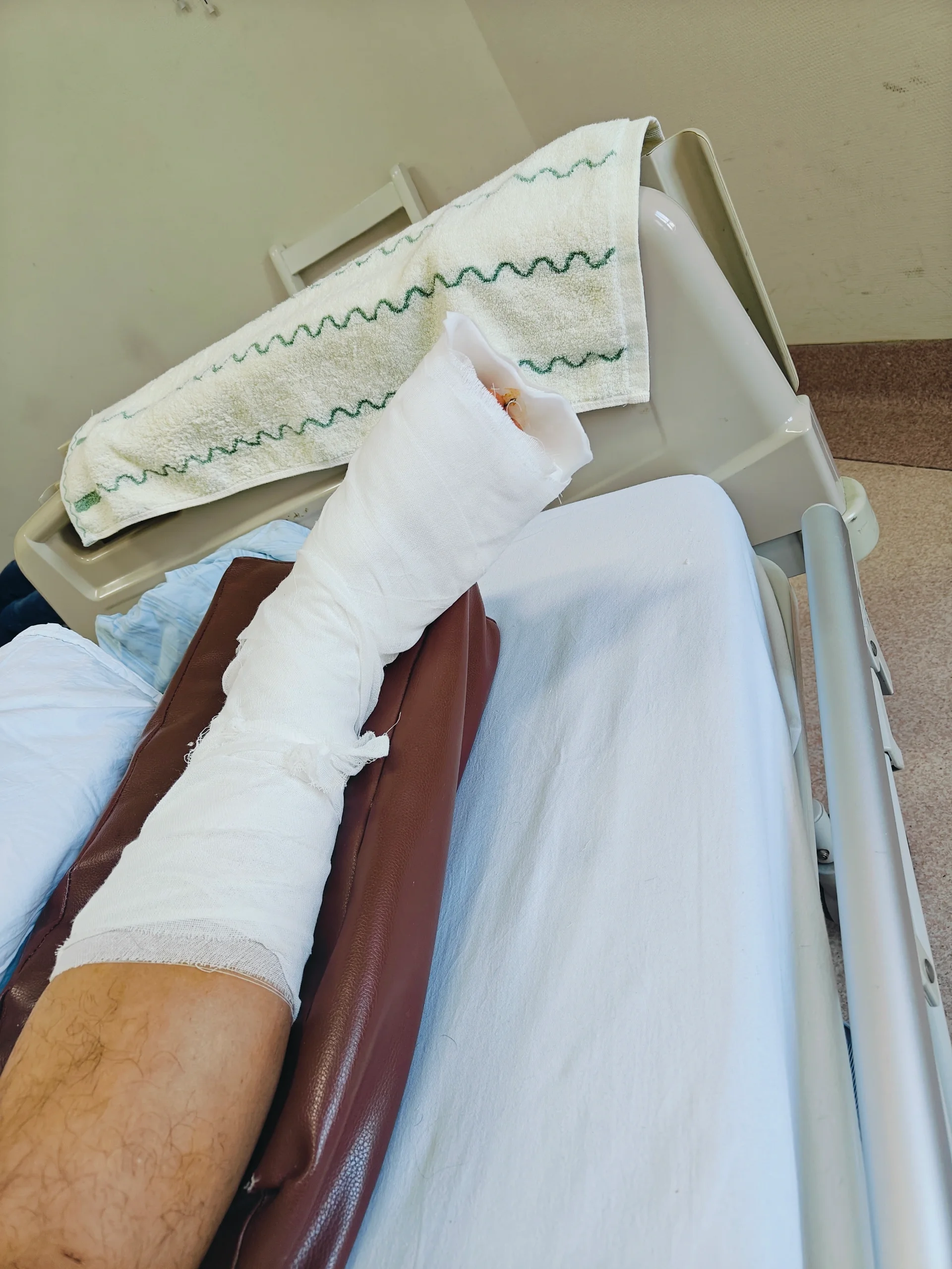 脚趾骨折 大脚趾骨裂当晚去附近医院用夹板固定第二天去专门骨科医院