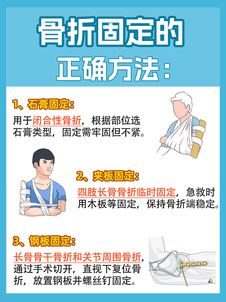 骨折固定方法u型石膏固定图解左前臂骨折固定包扎术流程图骨折处理