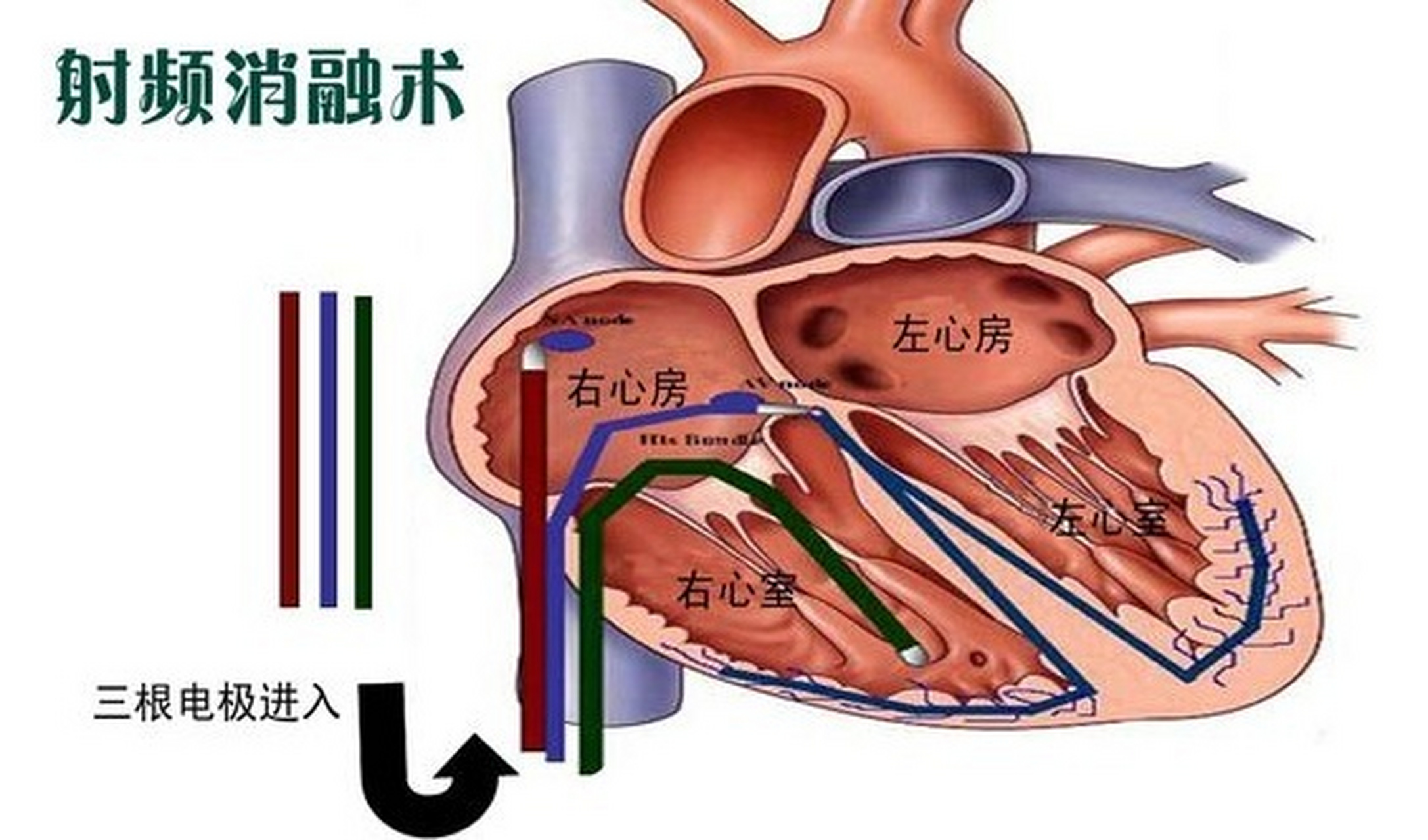 房颤做射频消融有风险吗?成功率多高?