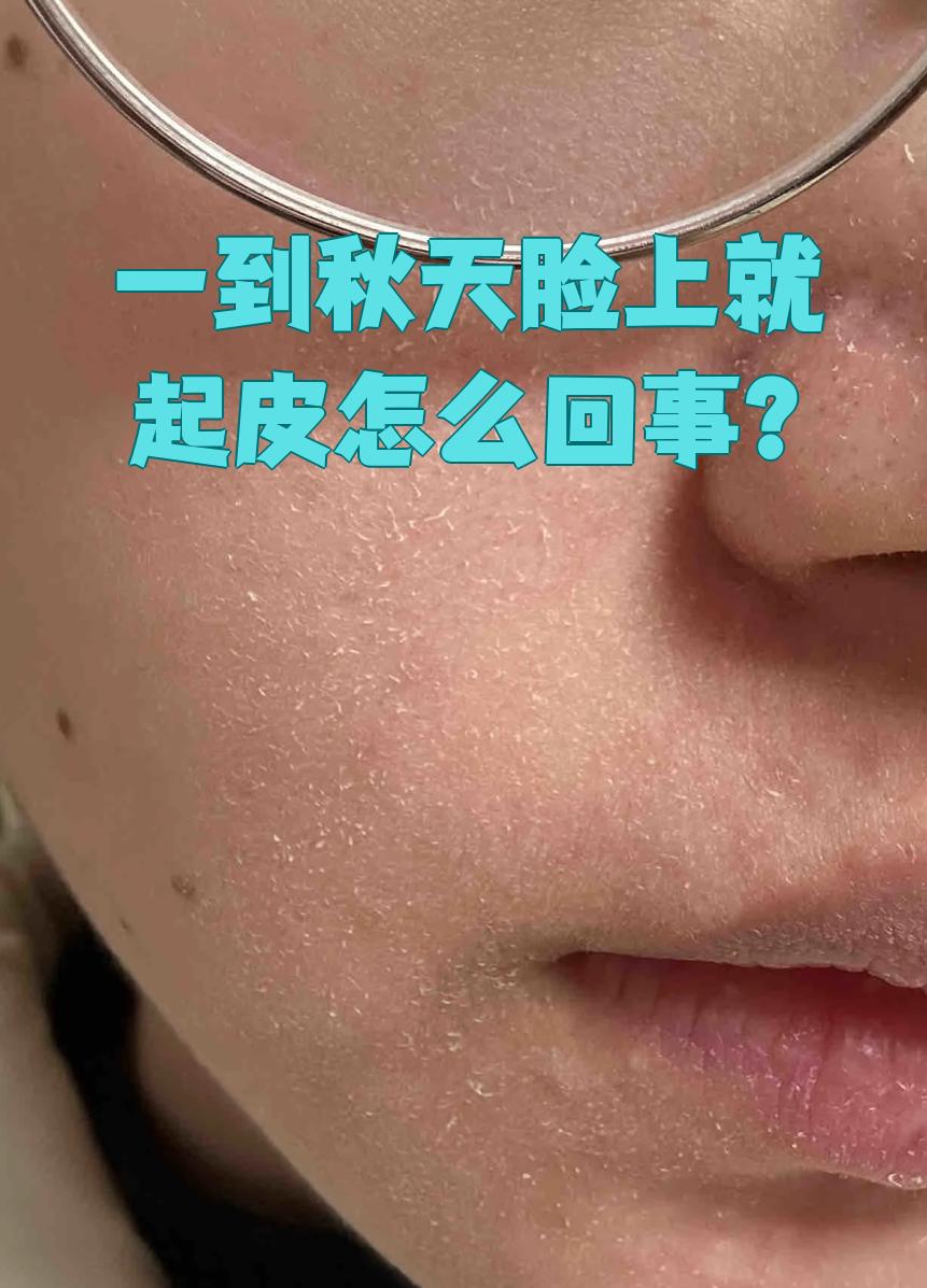 秋天脸上起皮很常见,主要是皮肤太干或者季节性脱皮引起的