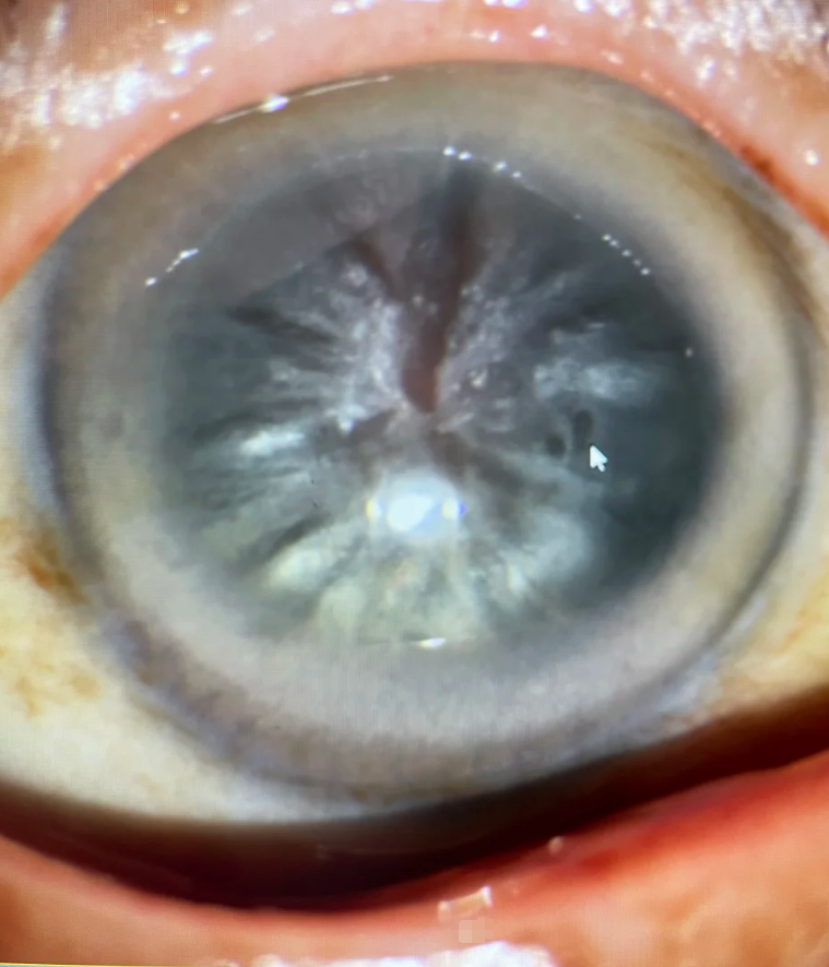 近视不会直接引起白内障,这两种眼病发病机制完全不同