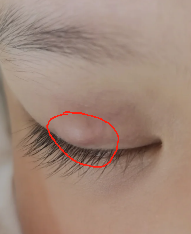 眼皮里面长了个包,可能是麦粒肿,霰粒肿或脂肪瘤引起的,需要根据