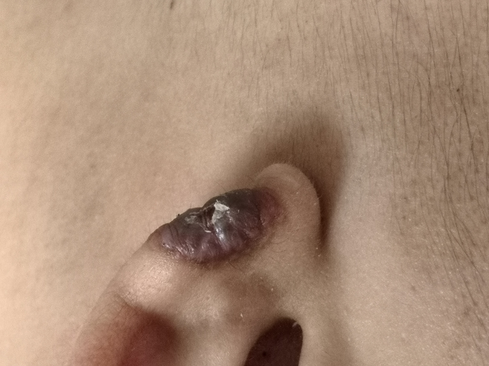 手术切除治疗也可以 #解决皮肤问题专注皮肤美容##纤维瘤