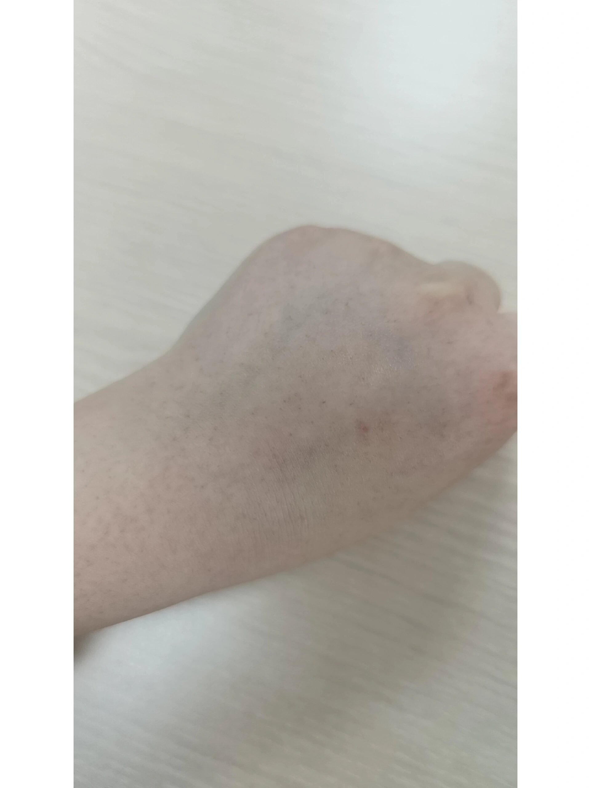 手背起密密麻麻的小红点 中午办公室趴着午睡了一会儿起来就匆忙出门