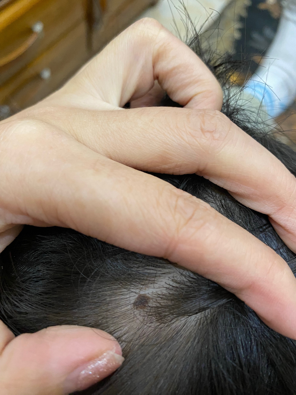 头皮色素痣.可以使用激光治疗去除或者手术切除治疗.#色素痣