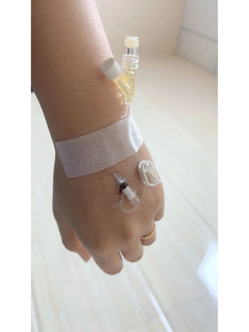 留置针回血 留置针第三天,回血整个手都麻木了,手肿的戒指都摘不下来