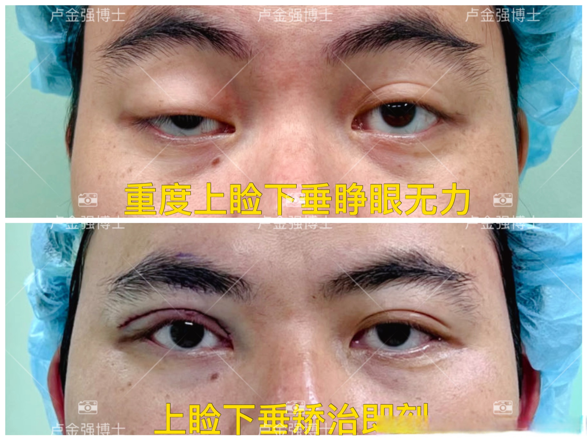 这是一位重度上睑下垂的患者,术前左眼提肌无力,遮挡瞳孔,比较影响