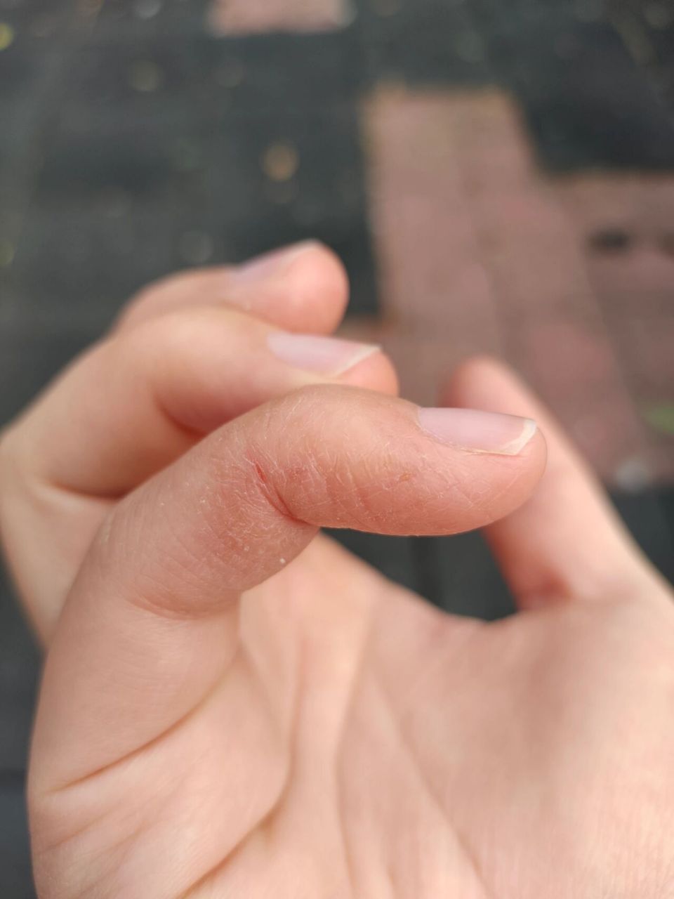 手指开裂啥原因啊? 有没有姐妹也这样啊?