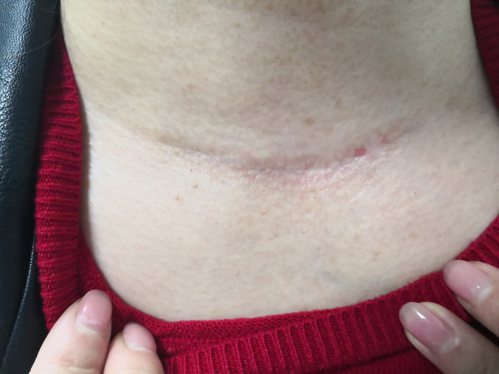 甲状腺手术切除后的疤痕症状#疤痕修复