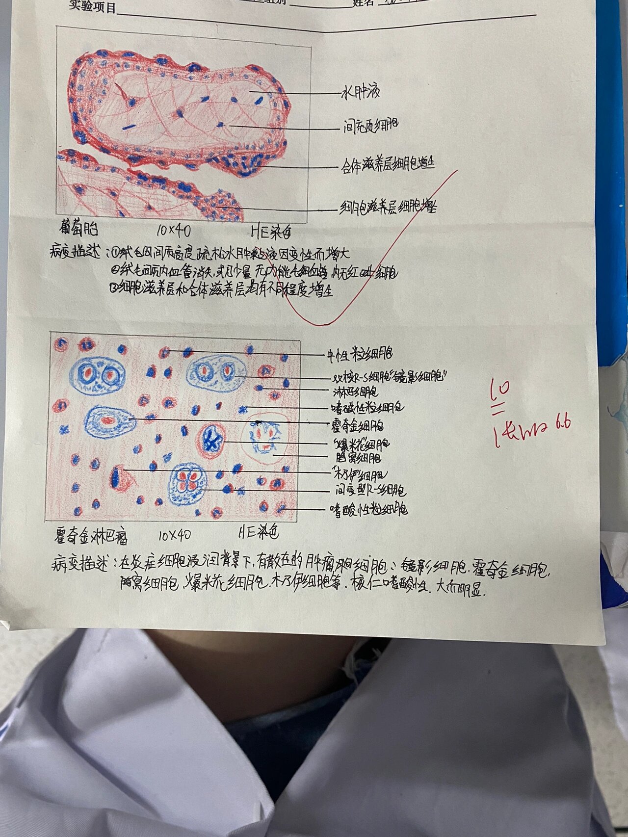 肾凝固性坏死手绘图图片