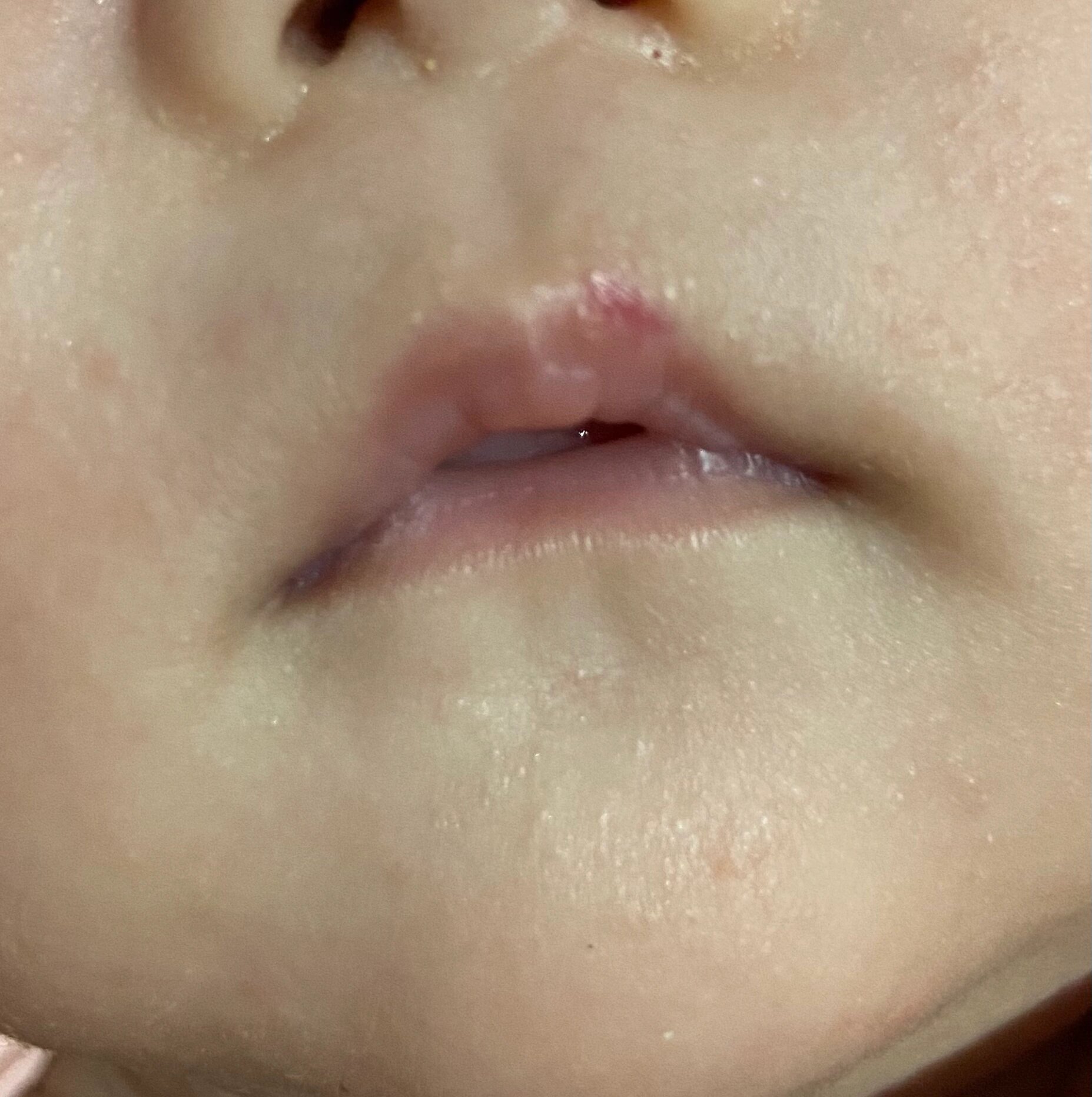 宝宝嘴唇血管瘤