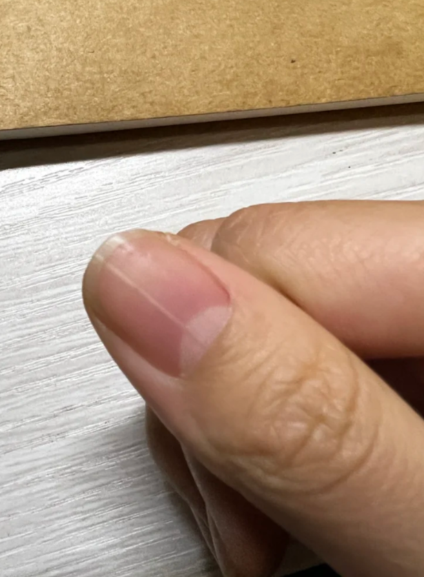 这种情况会使指甲变薄,变形,容易断裂,表面出现竖纹,同时指