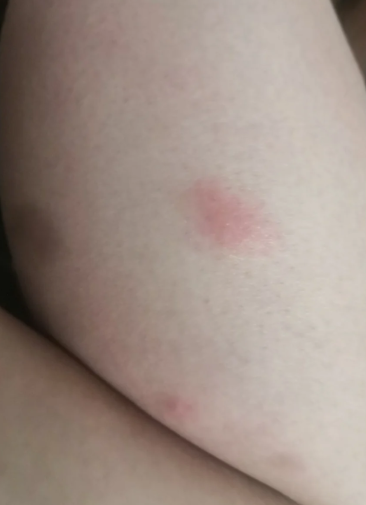 盐酸西替利嗪是一种抗组胺药,主要用于缓解过敏反应,比如皮肤瘙痒