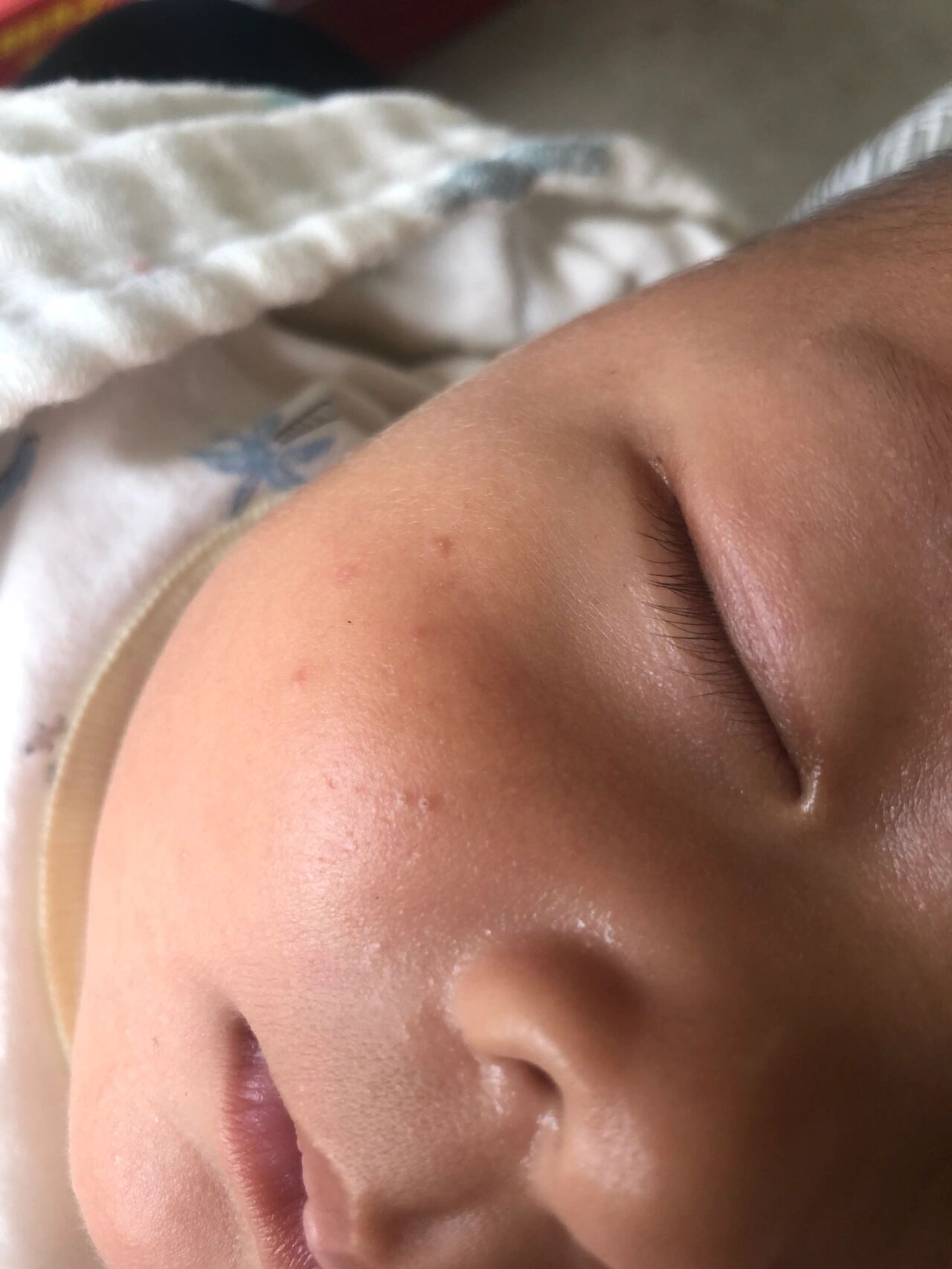 新生宝宝长粉刺