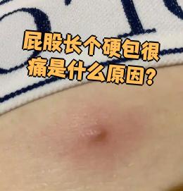 屁股上长了个硬包还很痛?