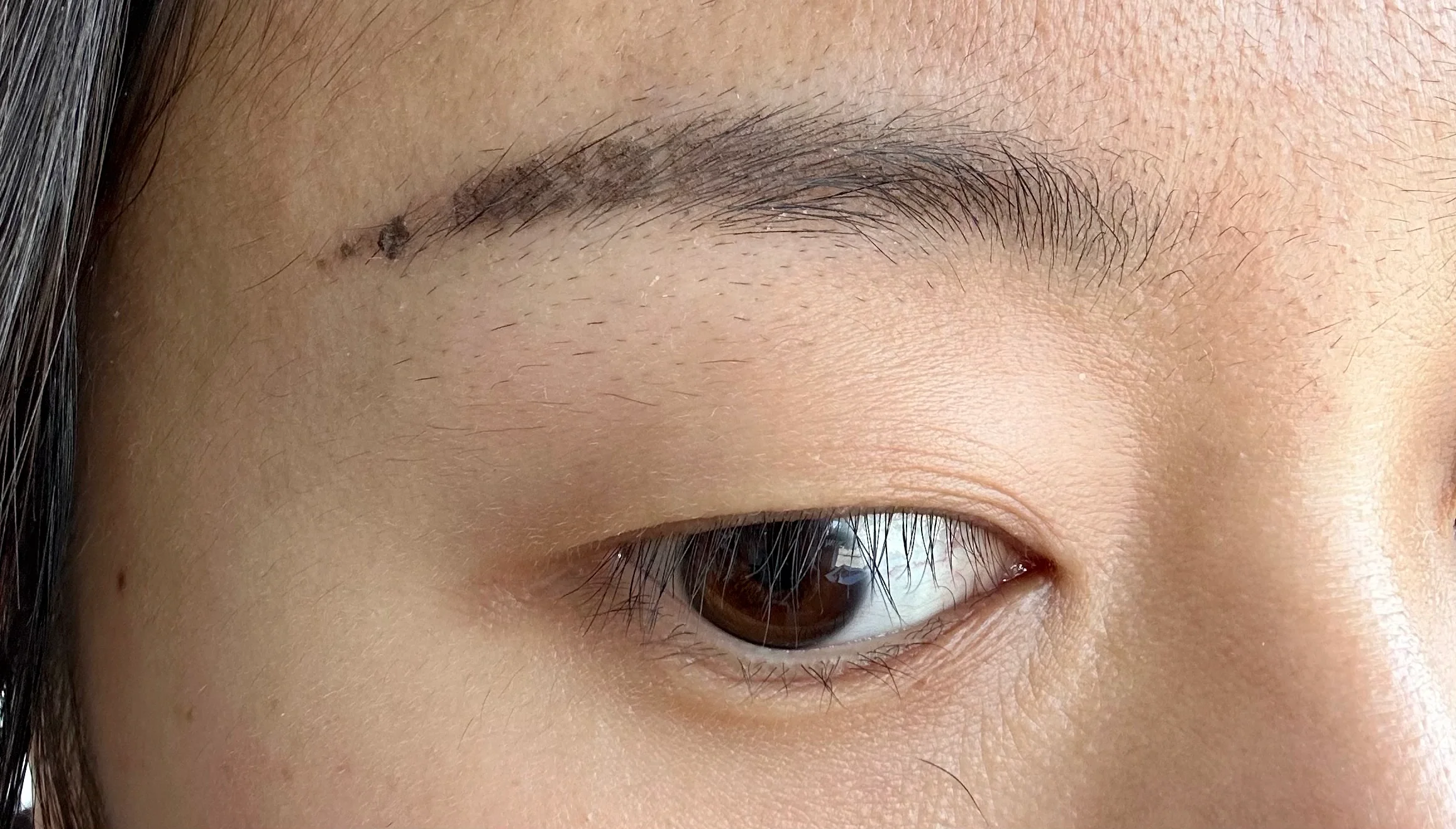 一天三次生理盐水湿敷,每次15min 掉了痂的地方发现几乎都没颜色了