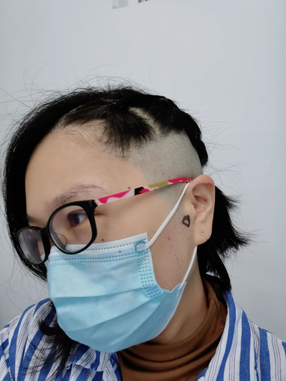 耳朵胆脂瘤手术后真实感受 自从上周被医生确诊后,就在网上各种搜索