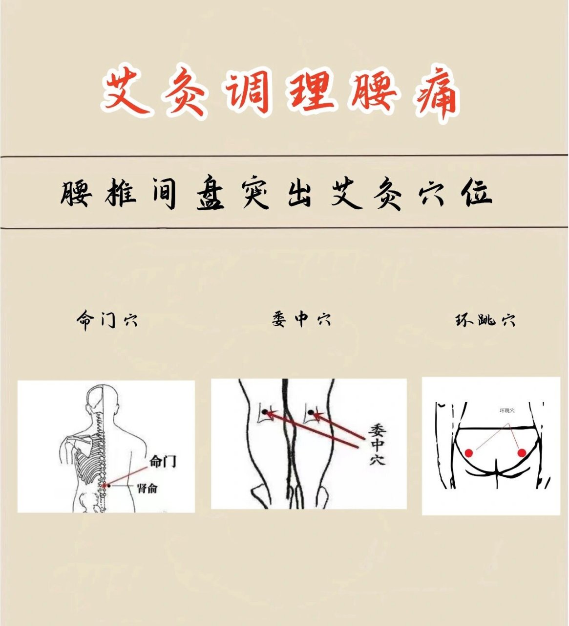 腰间盘突出艾灸;命门穴,委中穴,环跳穴.