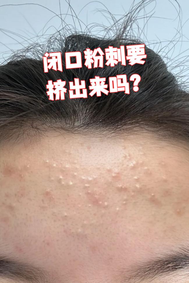 闭口粉刺要挤出来吗?